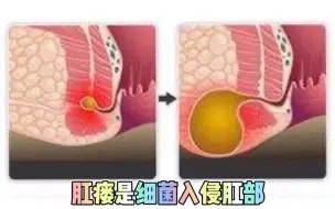 Скачать видео: 肛瘘竟然这么猛