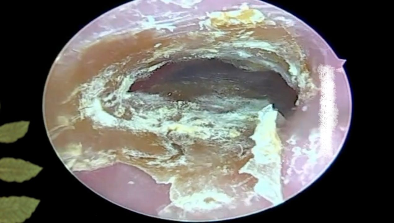 耳朵里好厚一层霉菌厚干片 !