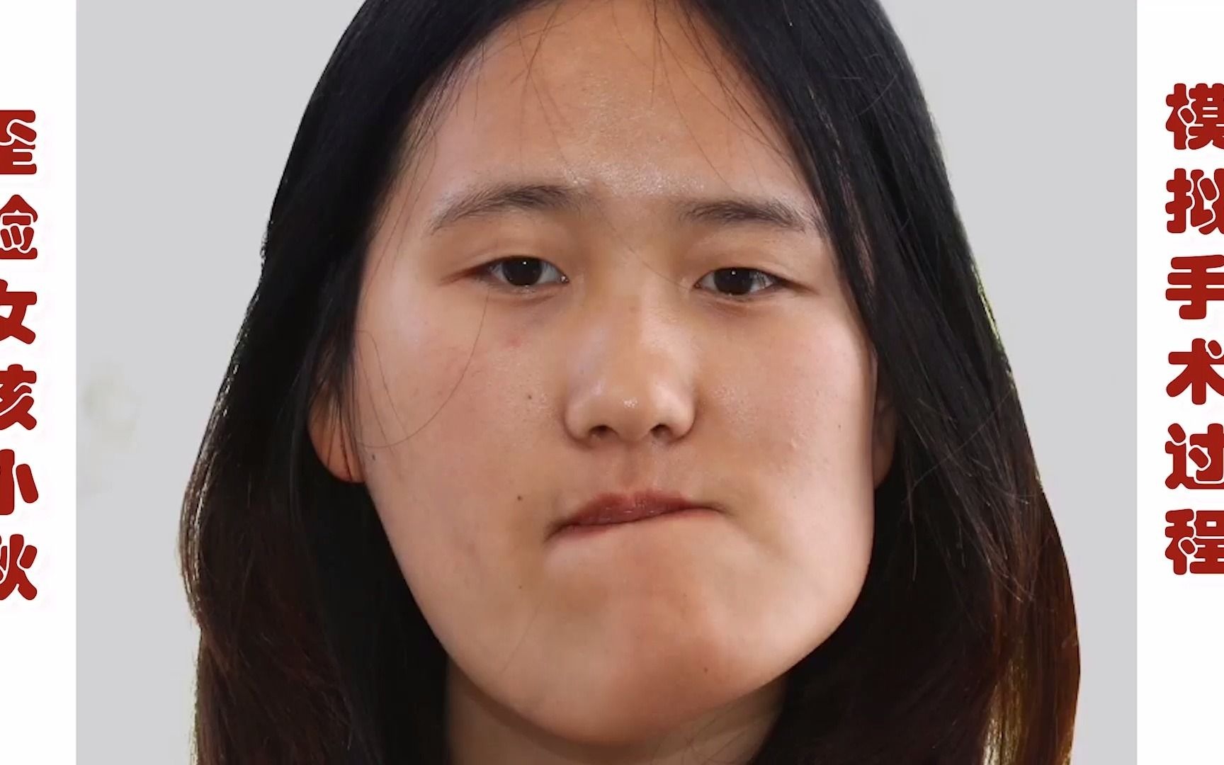 歪脸女孩变美记,7小时6项手术如何一次完成,3d模拟