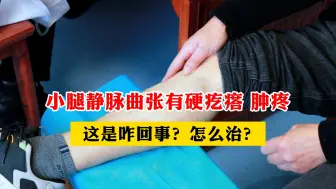 Download Video: 小腿静脉曲张有硬疙瘩 肿疼，这是咋回事？该如何治疗？