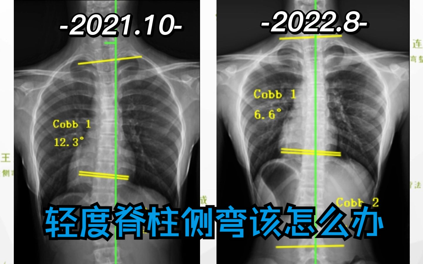 案例分析(四):轻度脊柱侧弯也不必惊慌——女孩脊柱侧弯经过10个月的治疗被成功治愈哔哩哔哩bilibili