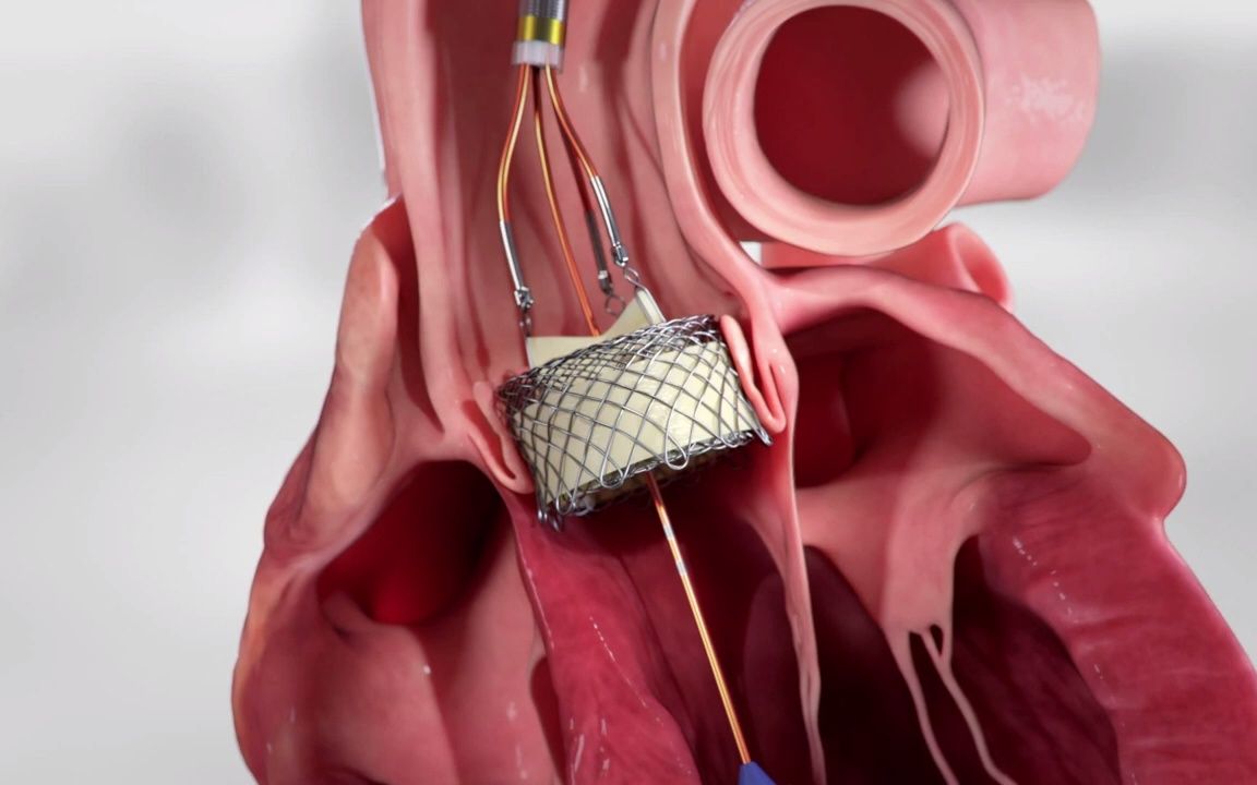 活动  hlt meridian tavr valve 新型可回收介入瓣膜
