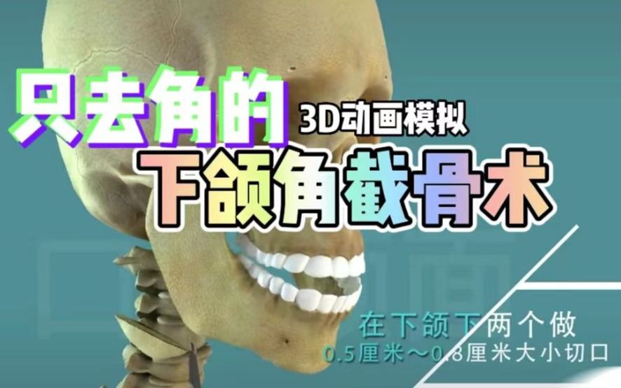 3D模拟轮廓手术|只去角的下颌角截骨术怎么做?哔哩哔哩bilibili