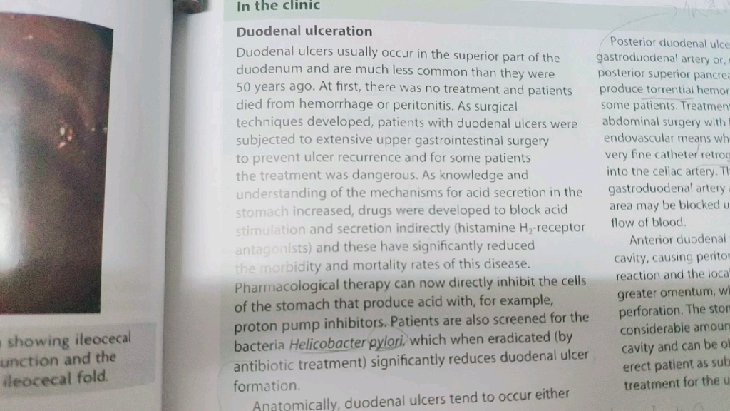 duodenal ulceration打卡哔哩哔哩bilibili