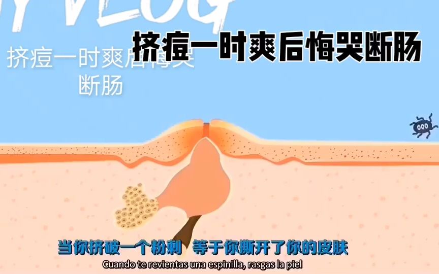 模拟挤痘痘解压,挤痘一时爽,后悔哭断肠~哔哩哔哩bilibili