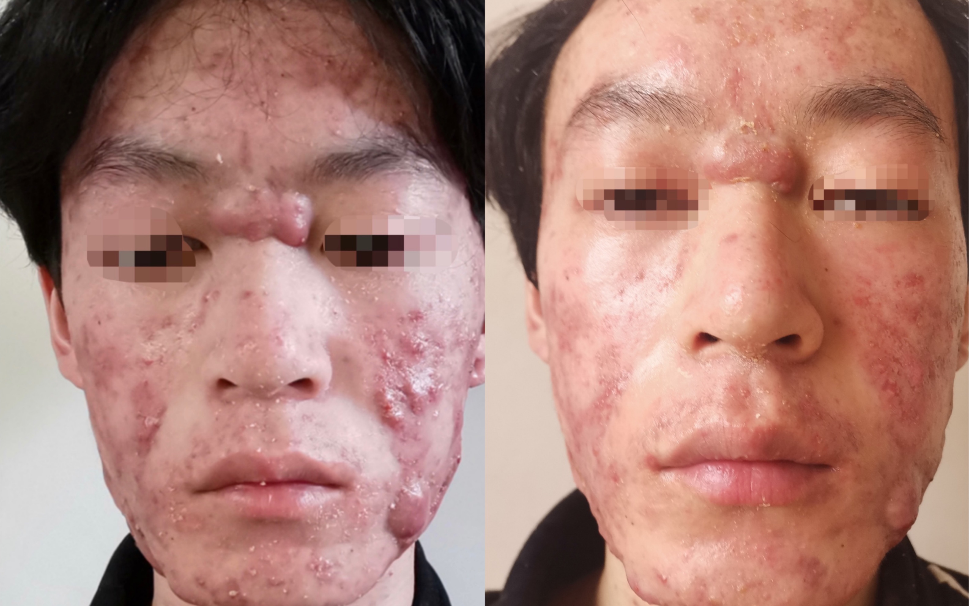 【重度囊肿】b站最严重痘痘没有之一|4天变化