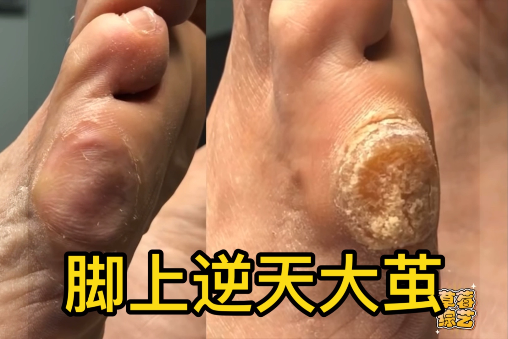 脚上逆天大茧