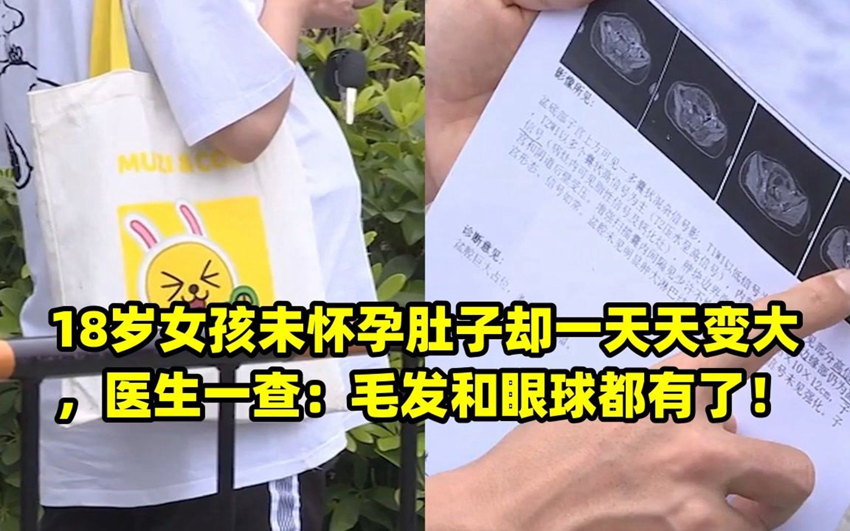 18岁女孩未怀孕肚子却一天天变大,医生一查:毛发和眼球都有了!