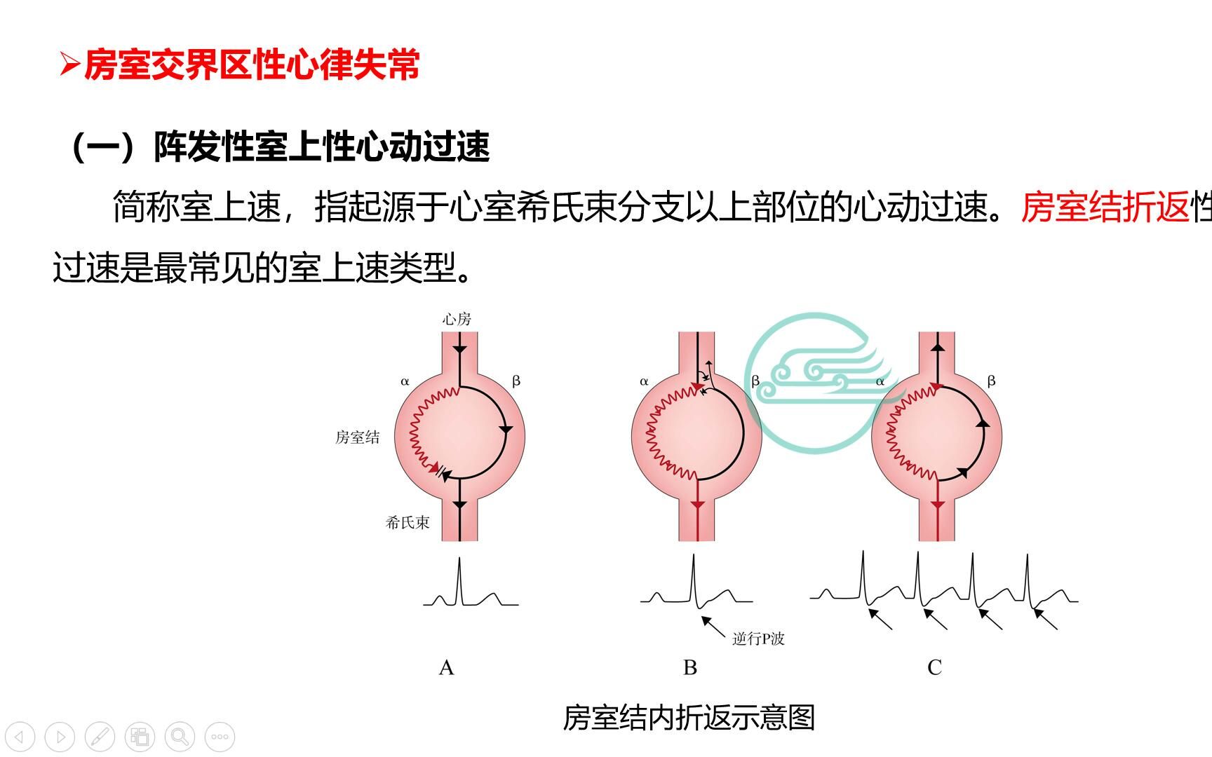 3、心律失常室上速哔哩哔哩bilibili