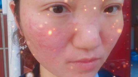 修复三件套治疗敏感肌激素脸的过程就是:打通的毛孔堵塞通道疏通出