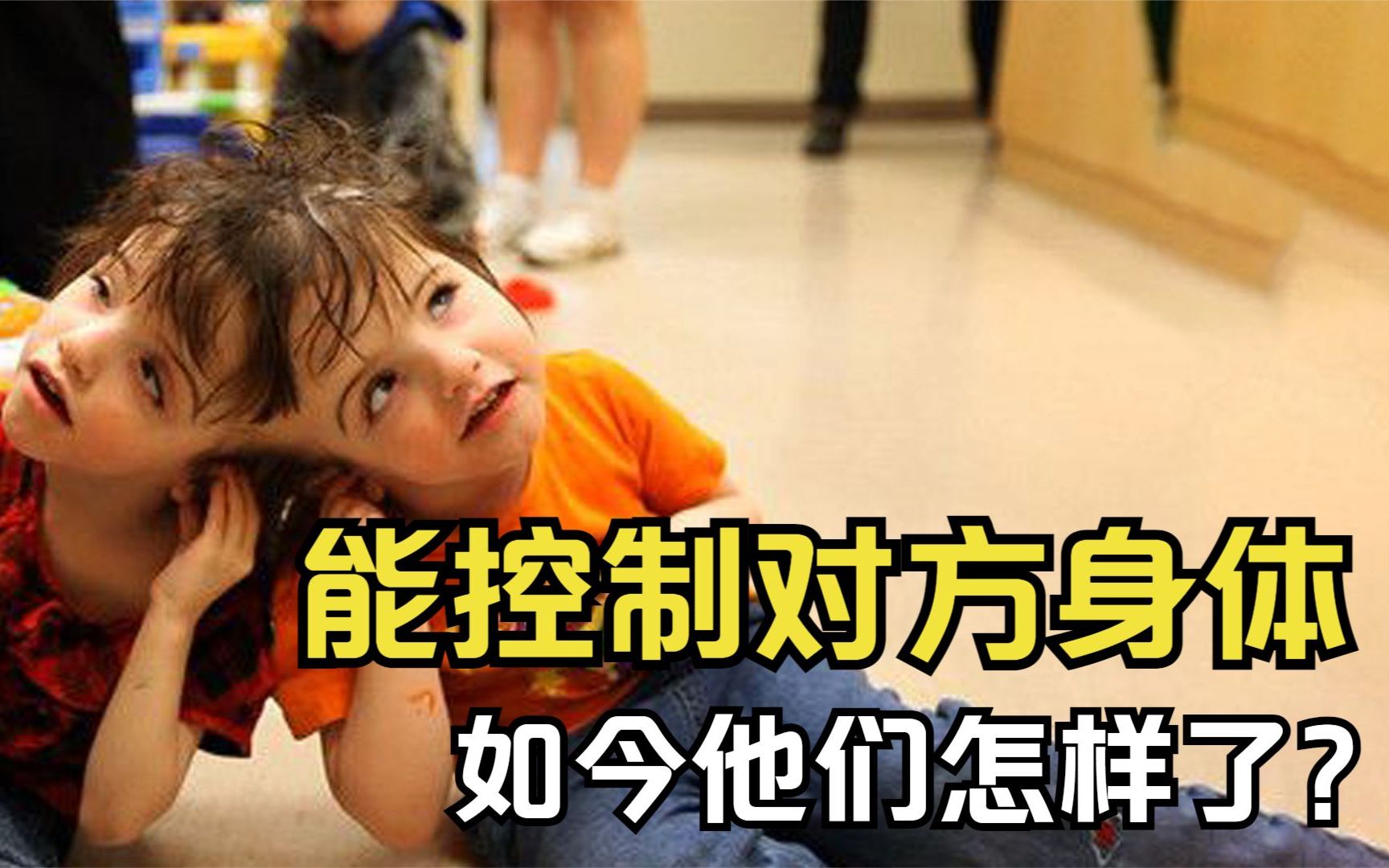 连体双胞胎:共用一个头,还能控制对方身体,如今她们怎样了?