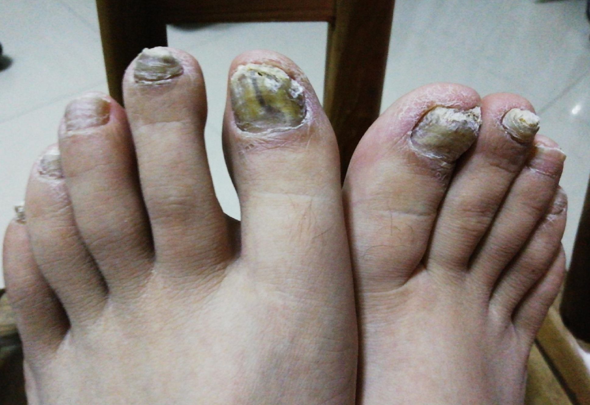 天热灰指甲"卷土重来"!3个妙招教你在家轻松搞定!赶紧收藏!