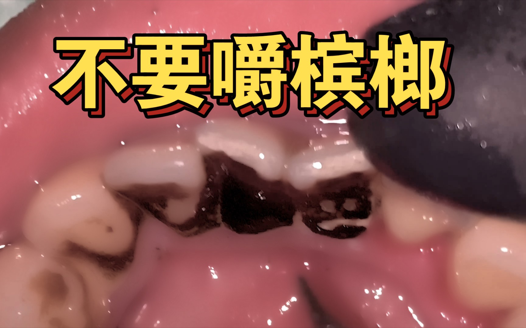 看看,嚼槟榔嚼的牙都成啥样了!