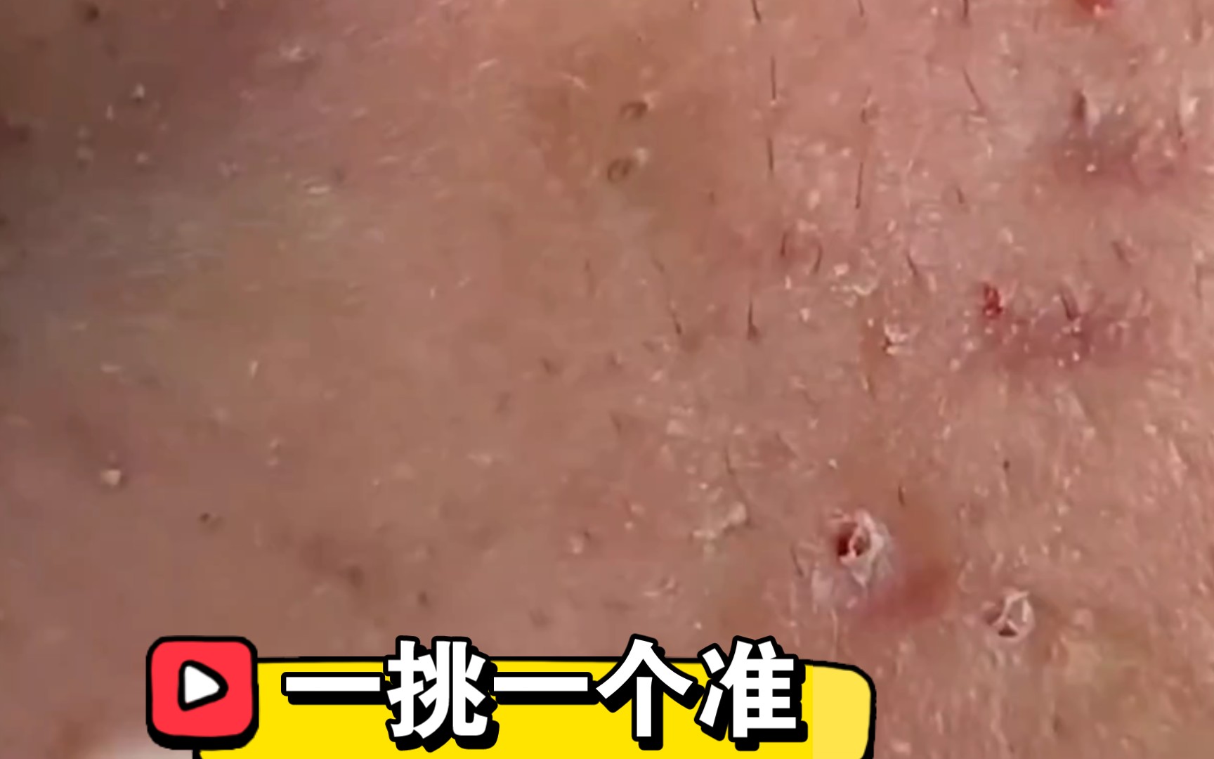 【解压】这脸有点不好发挥啊04挤痘痘挤黑头粉刺|爆浆痘痘沉浸式