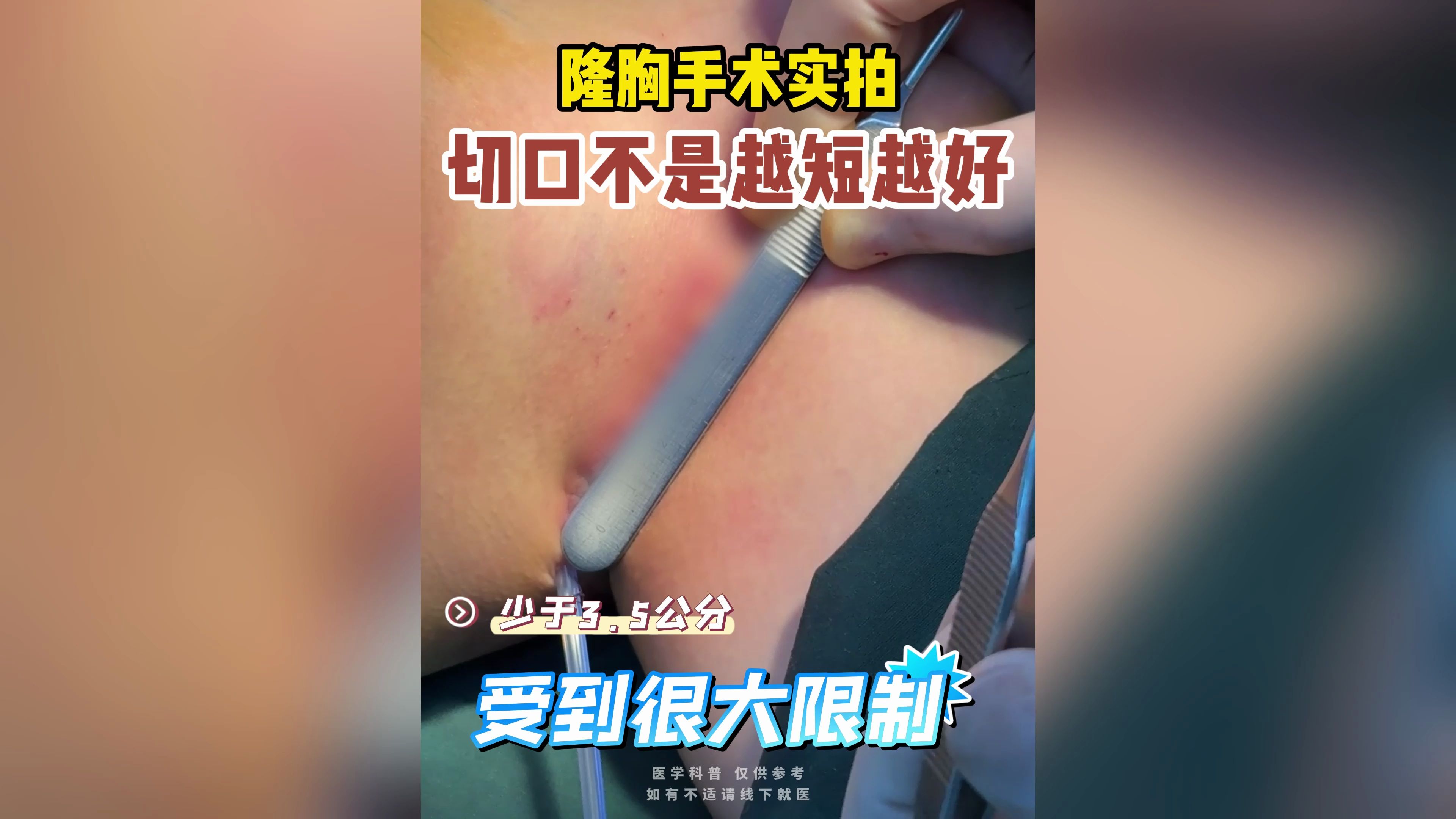 隆胸手术实拍,姑娘们切口不是越短越好哔哩哔哩bilibili