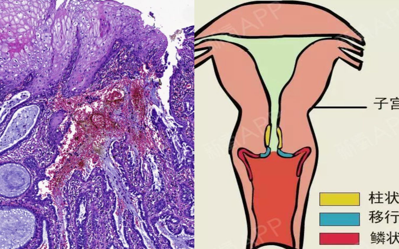 【小崔病理】23,宫颈鳞状上皮与柱状上皮形态(鳞状上皮看到蜘蛛样的挖空细胞)哔哩哔哩bilibili