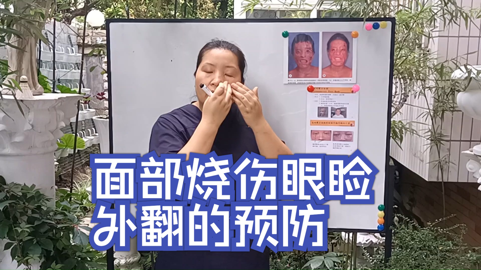 面部烧伤眼睑外翻的预防