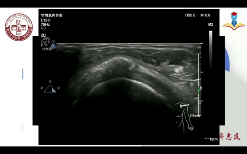 【肌骨超声】钙化性肌腱炎哔哩哔哩bilibili