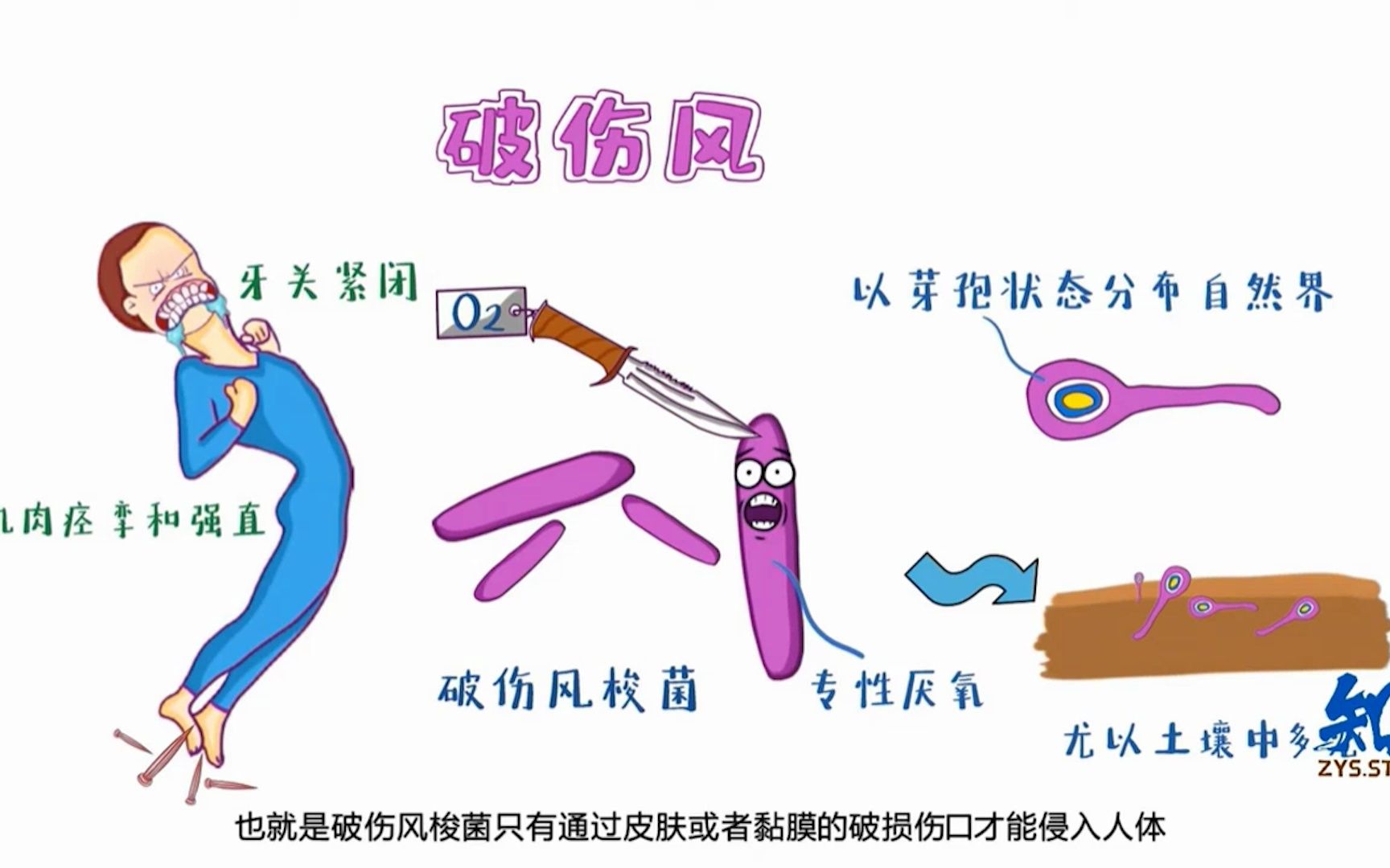 破伤风牙关紧闭图片