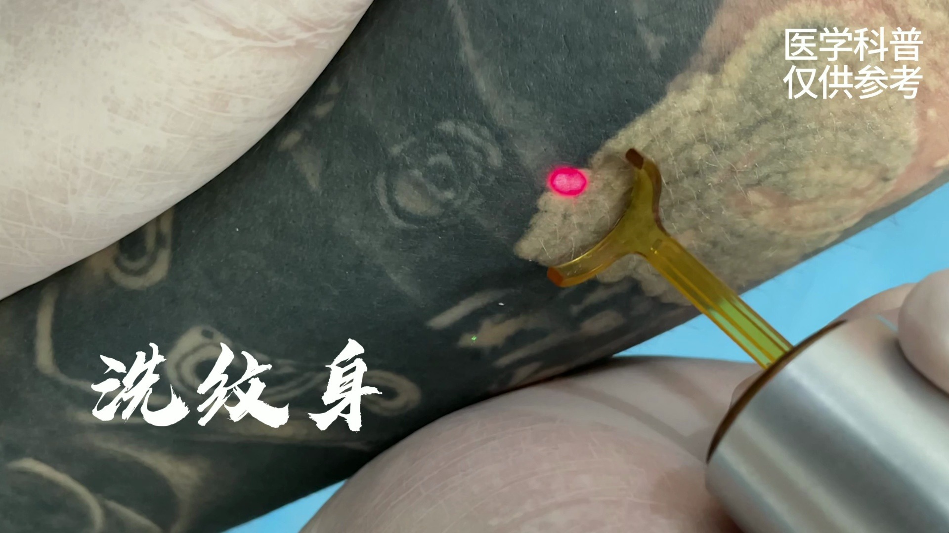 不破皮洗纹身