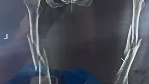 医学影像学x光右侧胫骨中下段骨折 右胫骨后踝骨折 右腓骨外踝骨折 伴关节周围软组织损伤 哔哩哔哩 Bilibili
