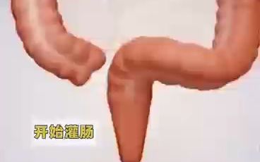 3D动画演示便秘灌肠的过程哔哩哔哩bilibili