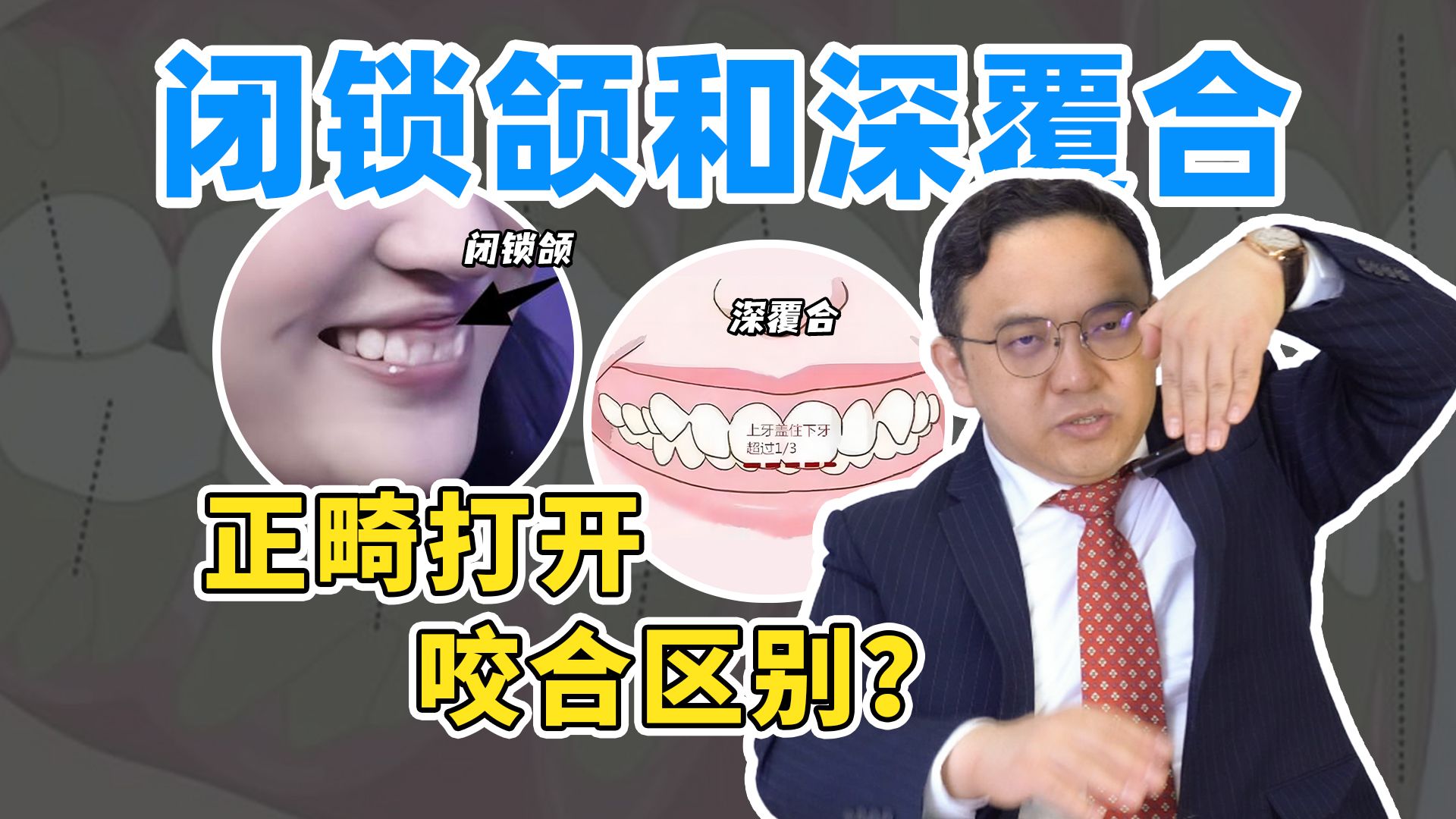 深覆合矫正必看!解锁闭锁性深覆合和深覆合正确打开咬合方式!