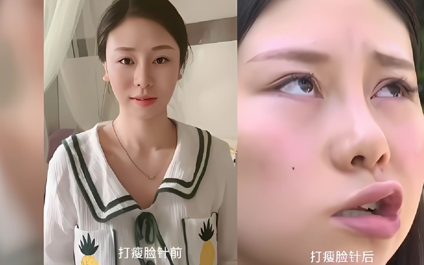 女子为了变美打了瘦脸针,结果导致自己嘴歪眼斜,医生:有可能终身面瘫!