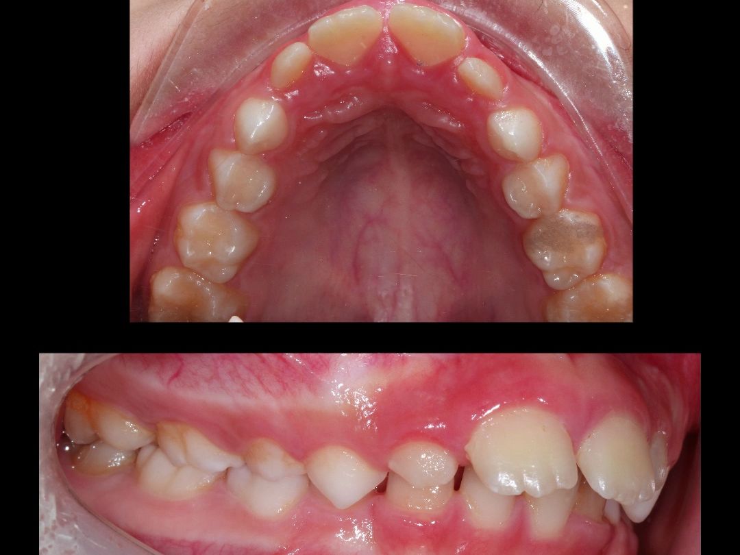 上颌牙弓狭窄 下颌后缩导出矫正