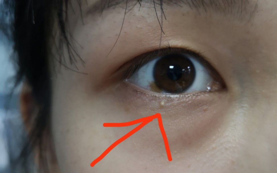 脂肪粒大作战上集