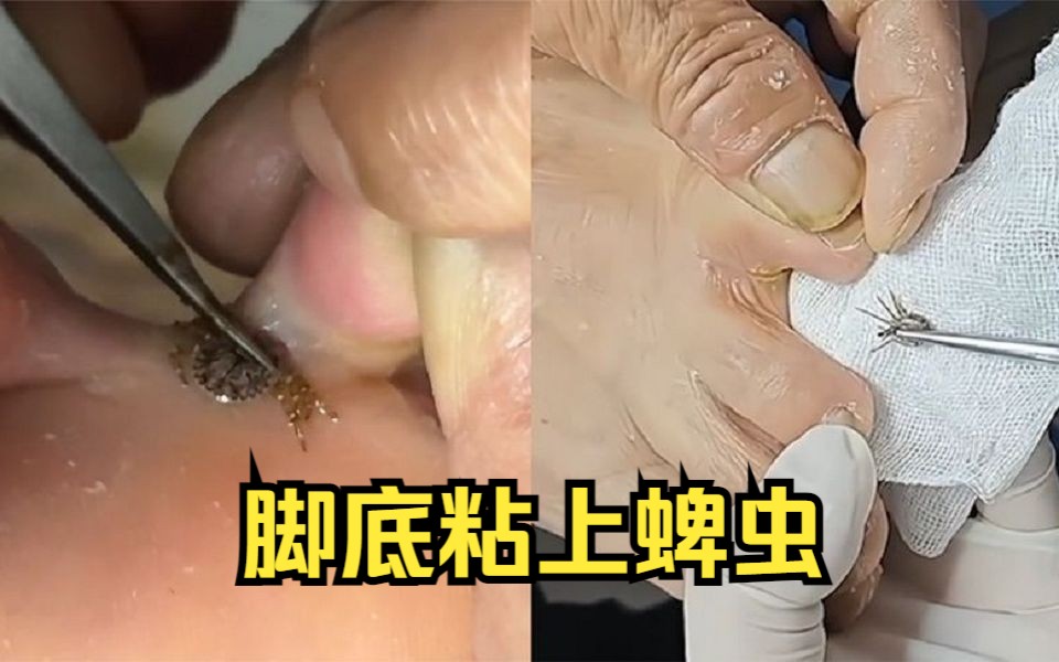 男子踏青后发现脚底有黑点,家人火烧硬拽无果,一查是蜱虫急送医哔哩哔哩bilibili