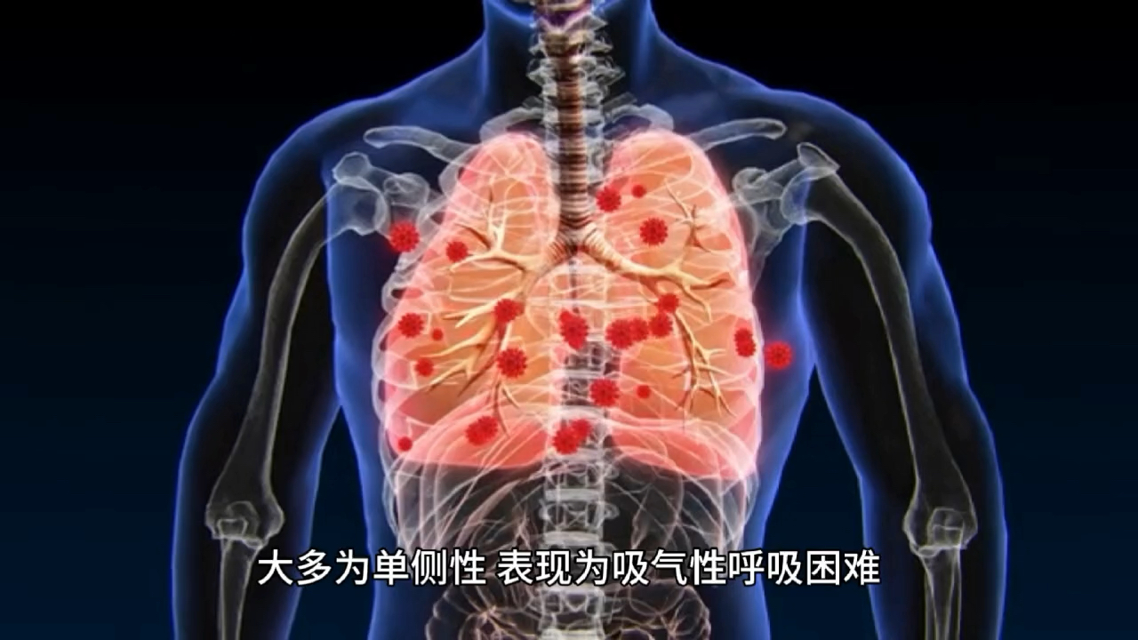 自发性气胸