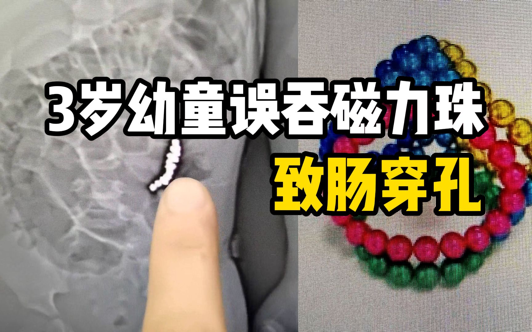 3岁幼童误吞磁力珠致肠穿孔医生不及时就医会有生命危险