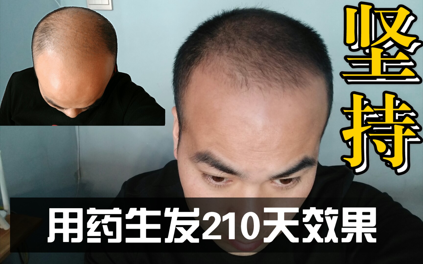 米诺地尔 非那雄胺 微针(用药生发210天效果) 自己做实验 生发记录片