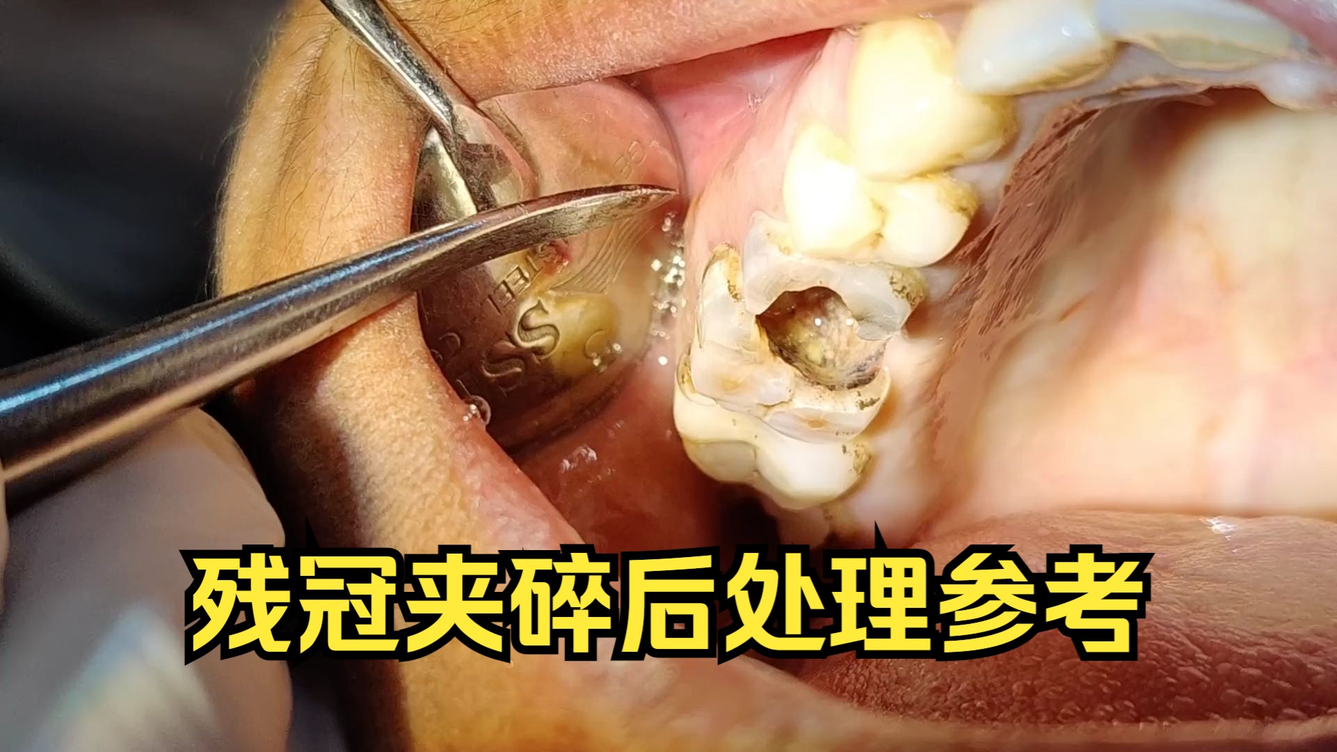 残冠夹碎后分根拔除