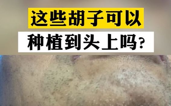 胡子可以种植到头上吗?男生种植5000单位反馈哔哩哔哩bilibili