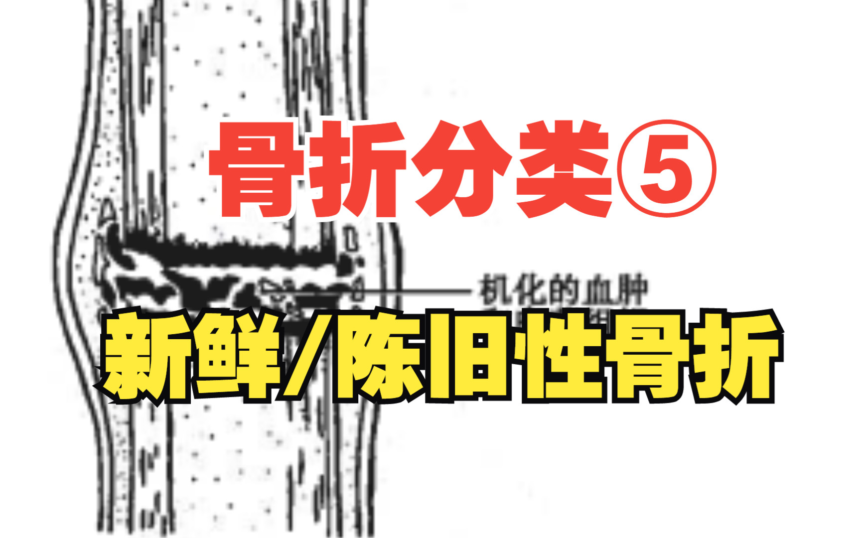 骨折概论8:骨折的分类⑤(新鲜/陈旧性骨折)哔哩哔哩bilibili