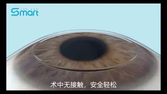 下载视频: Smart全激光近视矫正手术3D演示