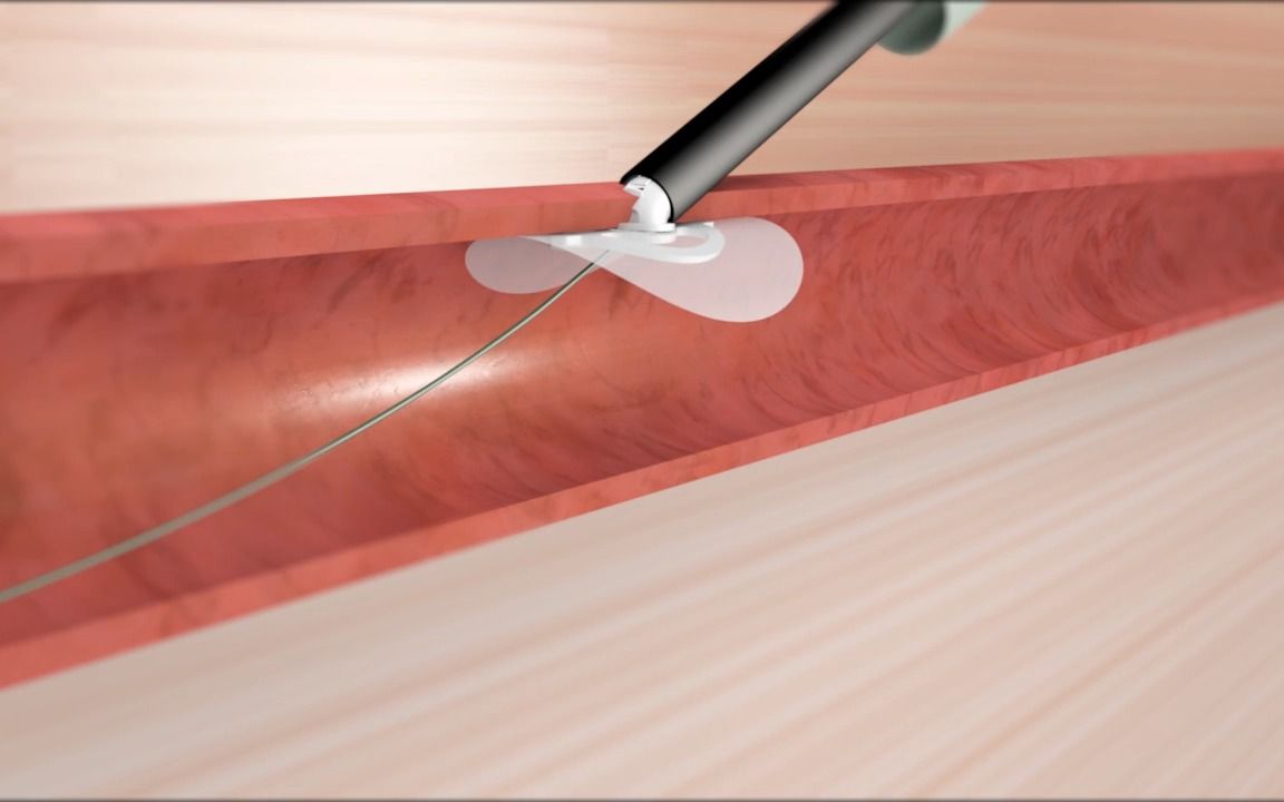 vivasure medical公司的血管闭合器械perqseal