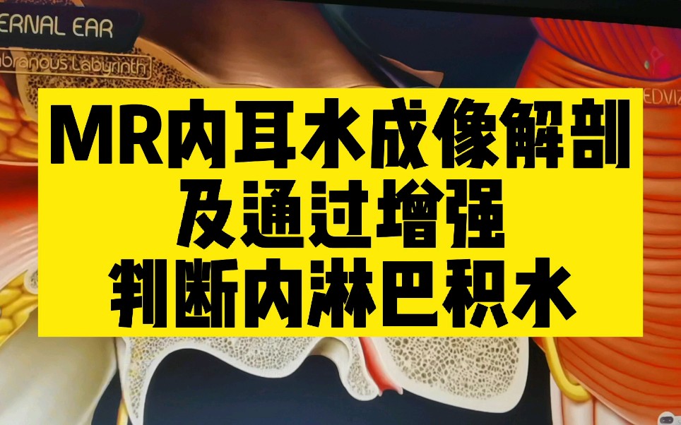 【解剖】头昏眩晕,内耳MRI磁共振水成像解剖,观察前庭耳蜗神经,内淋巴积水诊断!哔哩哔哩bilibili