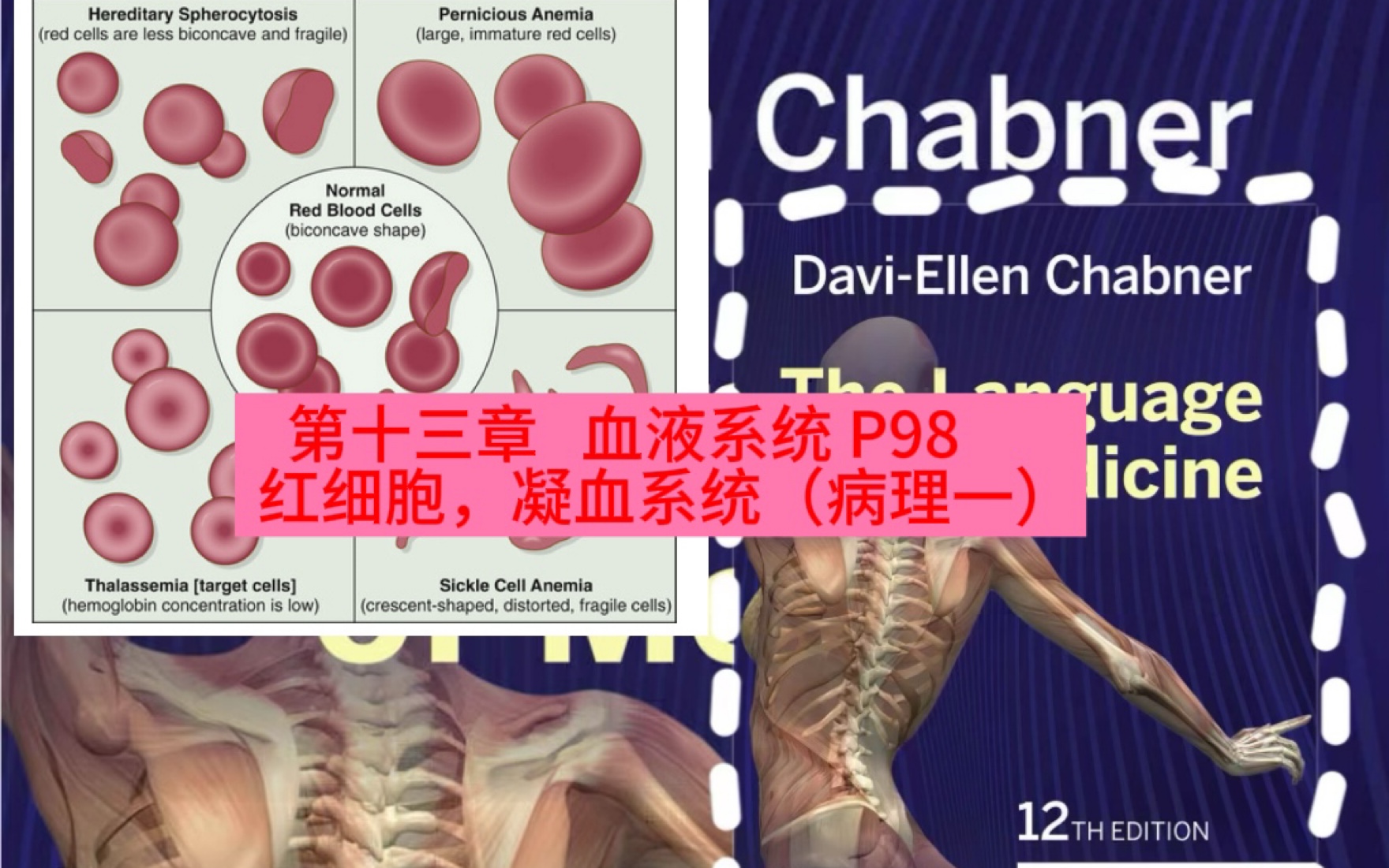 自学:6种贫血,血色病,红细胞增多症,血友病,紫癜!chapter13:the pathology of RBC and blood clotting P98哔哩哔哩bilibili