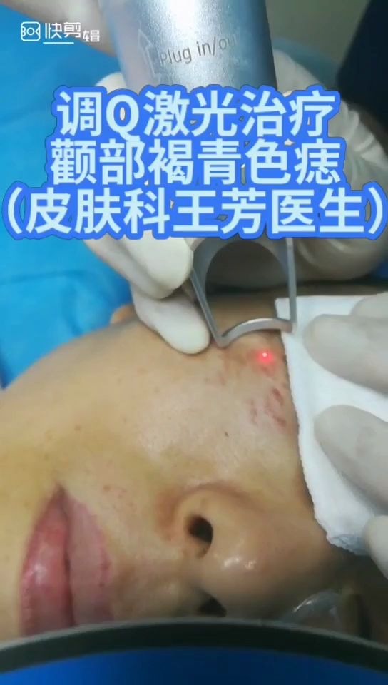 11.调q激光治疗颧部褐青色痣过程