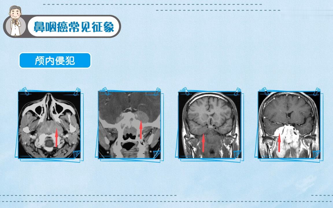 [3.3.1]33鼻咽癌哔哩哔哩bilibili