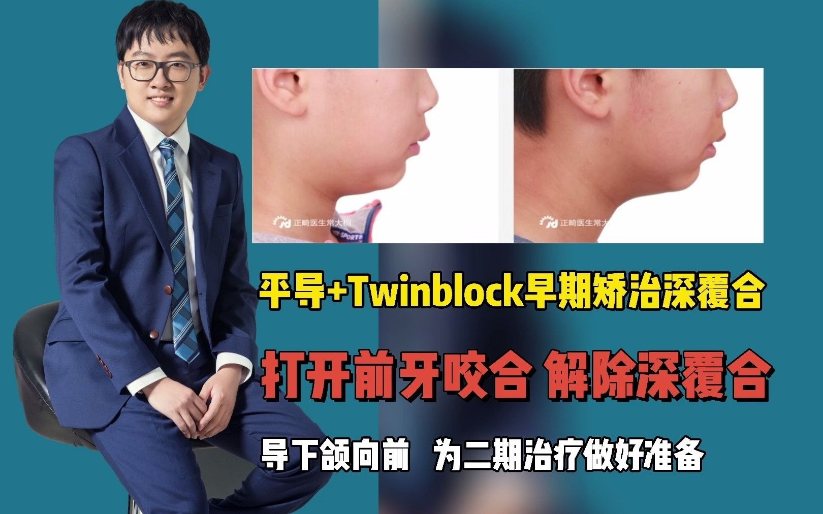 平导+Twinblock早期矫治深覆合,平导打开前牙咬合,解除深覆合,导下颌向前,为二期治疗做好准备哔哩哔哩bilibili