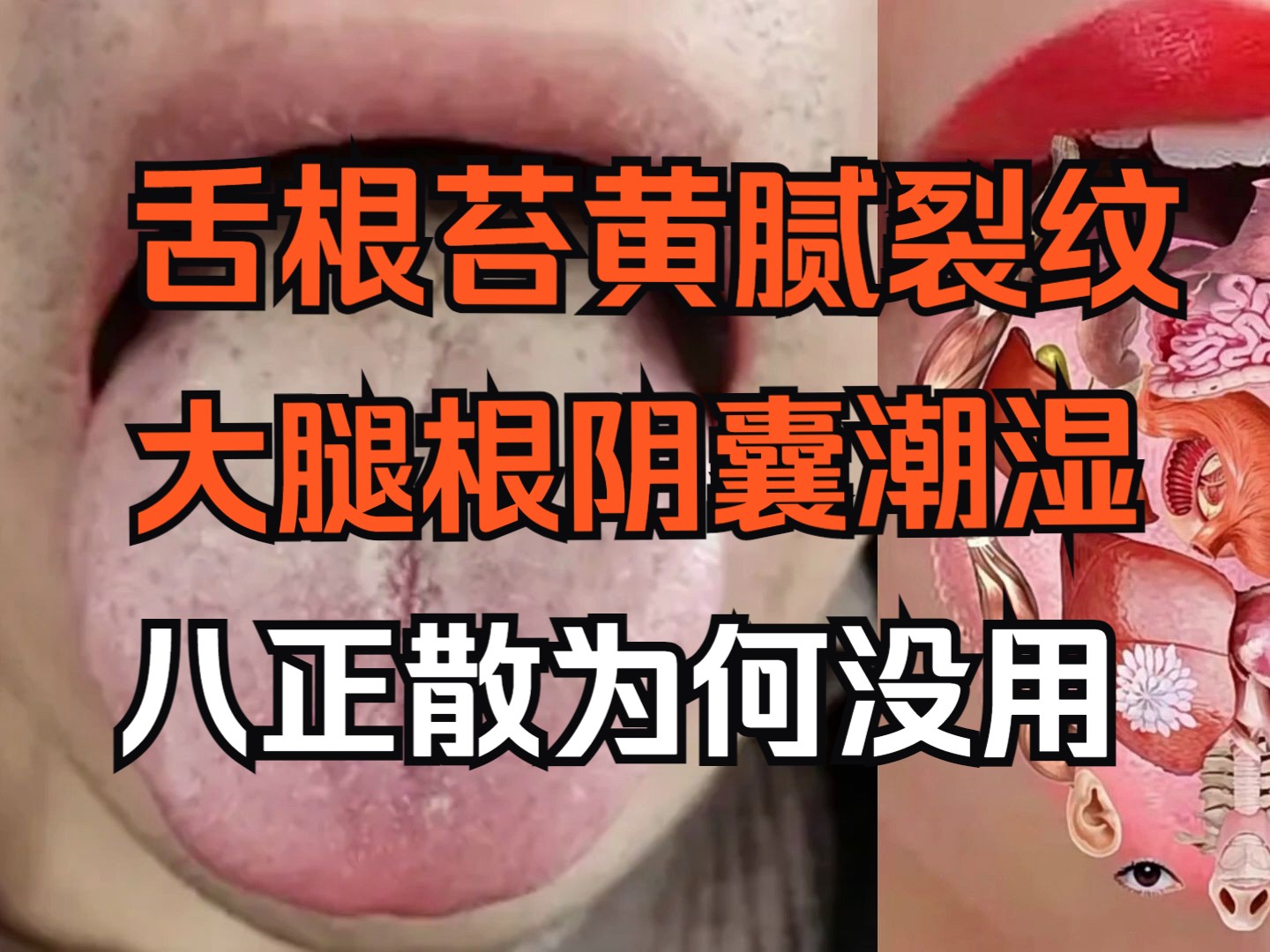 舌根舌苔黄腻,又有大腿根、阴囊潮湿,为什么八正散没用?哔哩哔哩bilibili