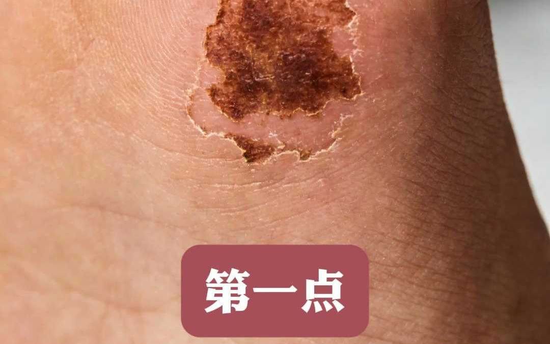 早期糖尿病足的5个特征