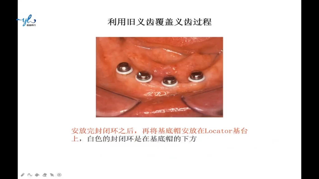 陈振亿老师种植修复系列课三之种植牙基台选择哔哩哔哩bilibili