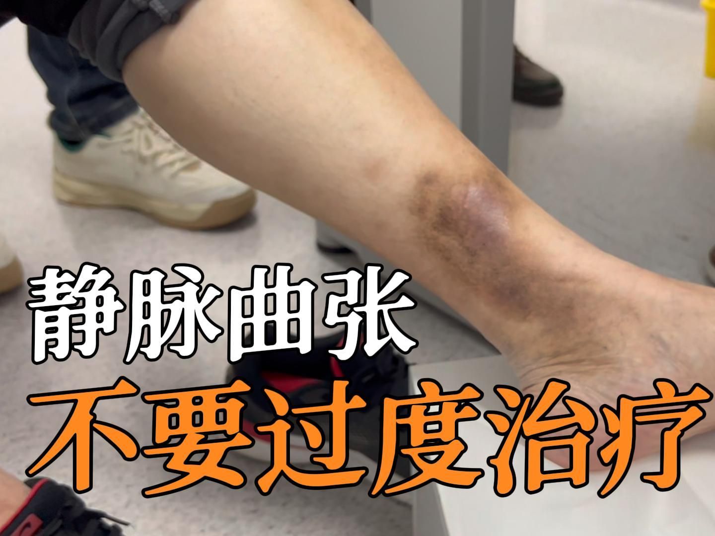 小小下肢静脉曲张差点放支架?过度治疗真的是为了患者好吗?