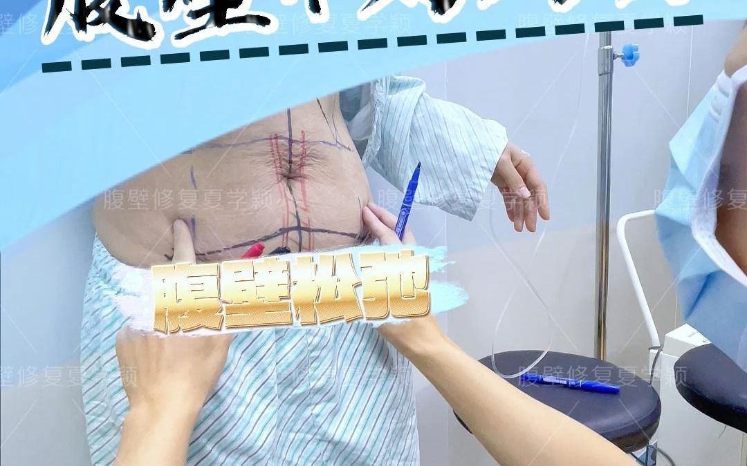 腹壁整形:主要是解决腹壁松弛和妈妈臀的问题