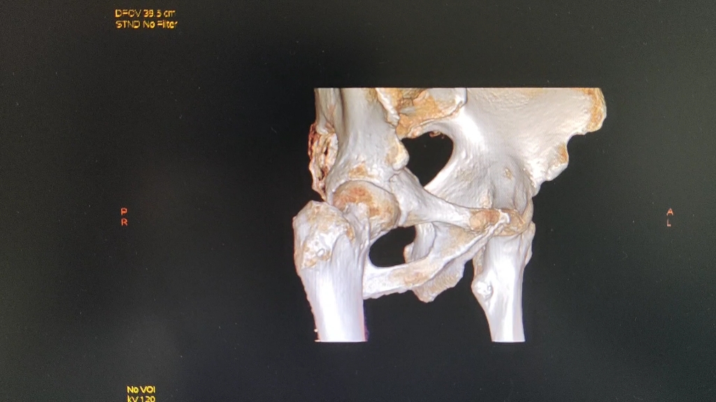 一个老年男性的髋关节三维